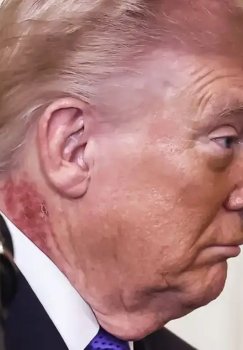 Trampning tanasidagi g‘alati belgilar matbuotda muhokamada