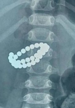 Bola 31 ta magnit yutdi: Shoshilinch operatsiya qilindi