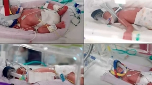 Avstraliyada o'ta noyob holatda to'rt nafar egizak dunyoga keldi
