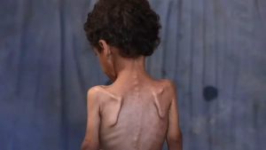 The number of hunger victims is increasing in the Gaza Strip