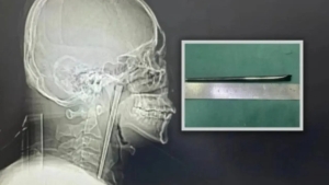 A Stick Remained in a Man's Throat for Eight Years in China