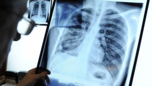 A patient diagnosed with lung cancer lived for 40 years
