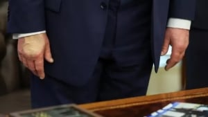 Trampning qo‘lida ko‘karish va oyoq shishi kuzatildi