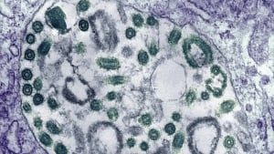 Marburg virus outbreak in Ethiopia raises concerns