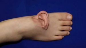 Doctors kept the ear standing and restored it