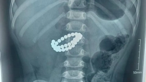 Bola 31 ta magnit yutdi: Shoshilinch operatsiya qilindi