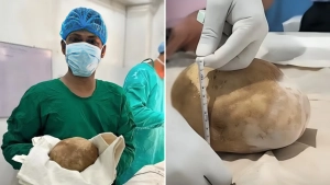 Shri-Lanka shifokorlari bemor tanasidan uch kilogrammlik toshni oldi