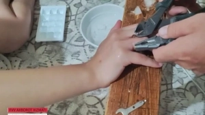 Rescuers removed a finger ring in Nukus