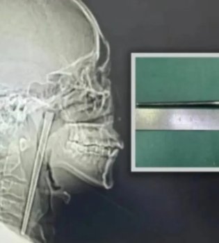 A Stick Remained in a Man's Throat for Eight Years in China