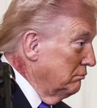 Странные отметины на теле Трампа обсуждаются в прессе