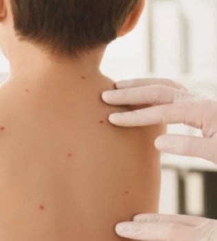 В Алматы среди детей растет заболеваемость ветряной оспой