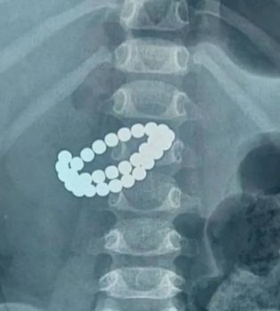 Ребенок проглотил 31 магнит: Срочная операция проведена