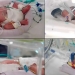 Avstraliyada o'ta noyob holatda to'rt nafar egizak dunyoga keldi