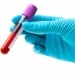 Gallery test detects cancer at an early stage