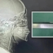 A Stick Remained in a Man's Throat for Eight Years in China