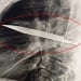 An eight-year-old knife was removed from the breast in Tanzania