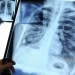 A patient diagnosed with lung cancer lived for 40 years