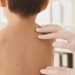 Chickenpox cases are increasing among children in Almaty
