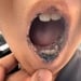 Rare Peutz–Jeghers Syndrome Diagnosed in Kyrgyzstan