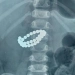 Child swallowed 31 magnets: Emergency surgery performed