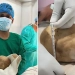Shri-Lanka shifokorlari bemor tanasidan uch kilogrammlik toshni oldi
