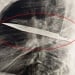 An eight-year-old knife was removed from the breast in Tanzania
