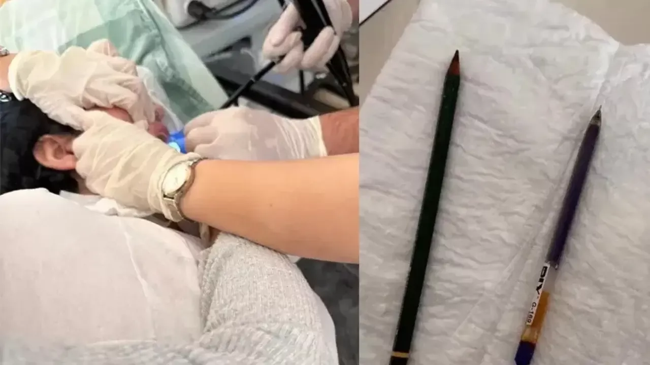 Agri shifoxonasida oshqozondan ikki ruchka olindi