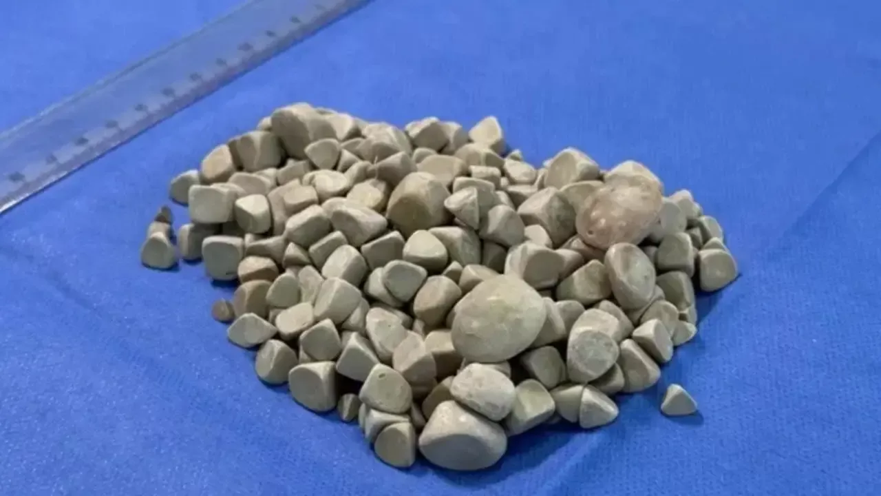 287 stones removed from a 21-year-old girl in Karabuk