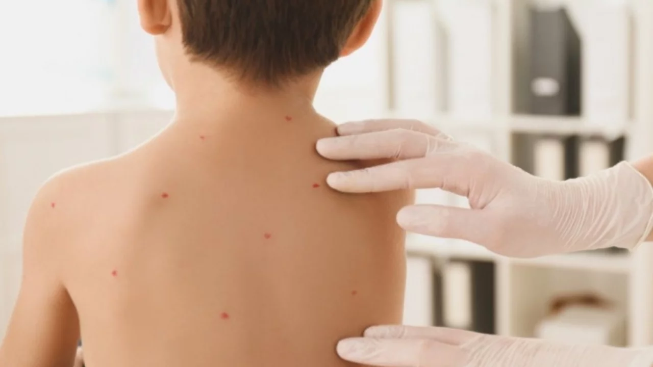 Chickenpox is increasing among children in Almaty