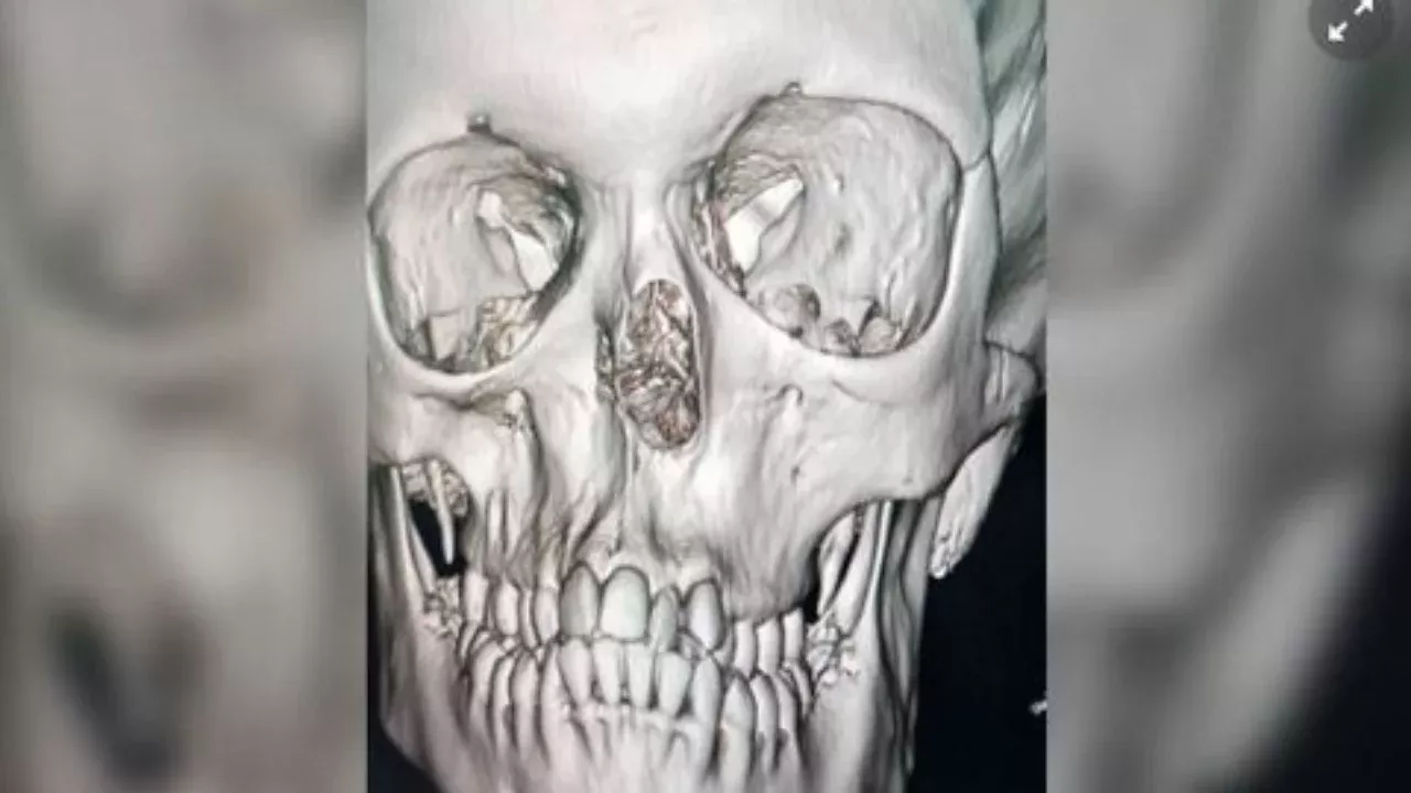 Novosibirskda 14 yildan keyin burun tiklandi