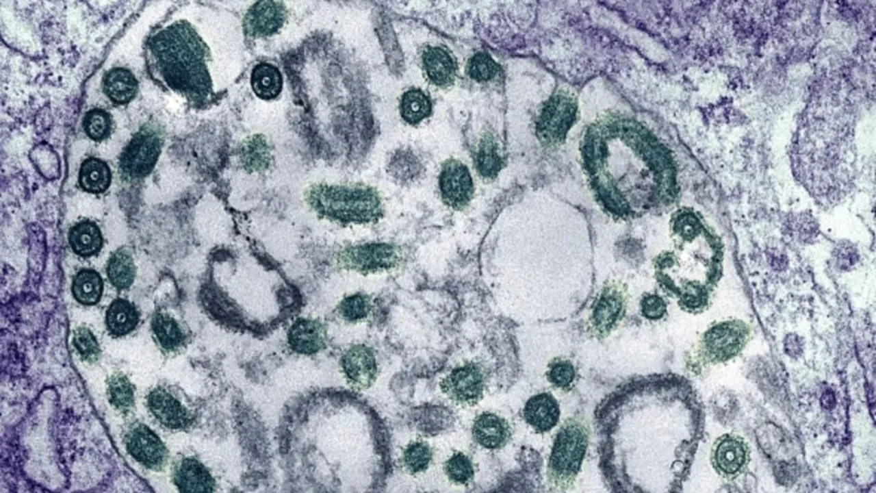 Marburg virus outbreak in Ethiopia raises concerns