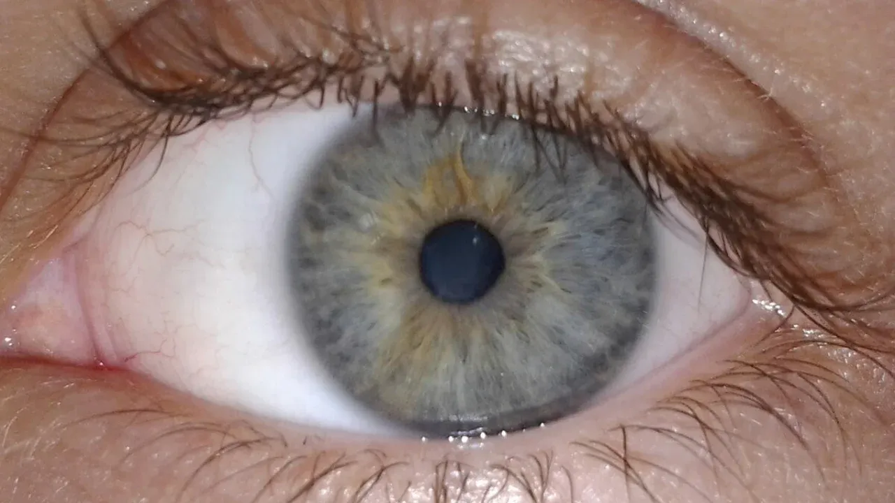 Ayolning ko‘zidan tirik parazit olib tashlandi