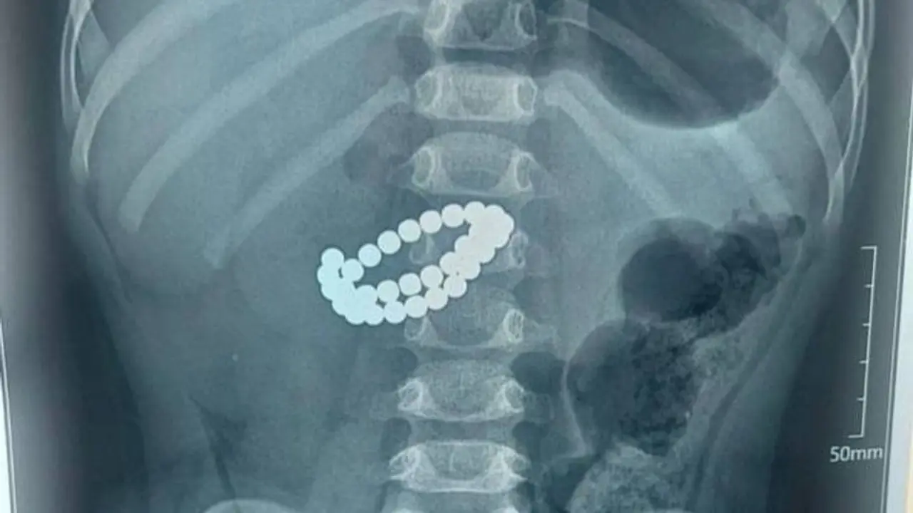 Bola 31 ta magnit yutdi: Shoshilinch operatsiya qilindi