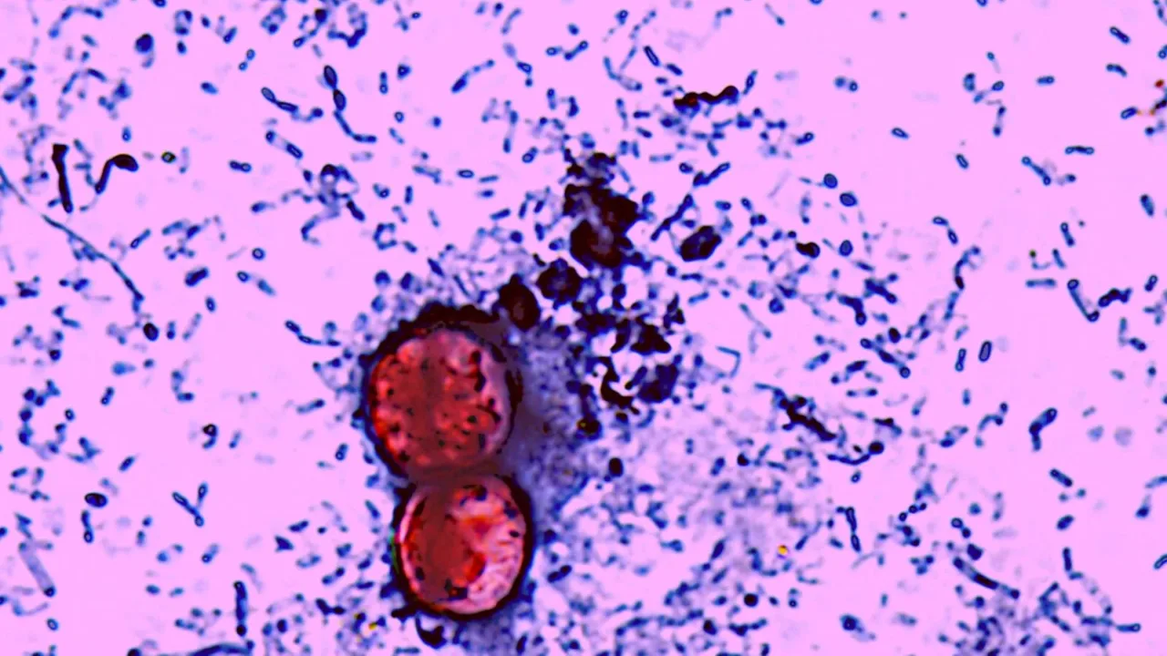 AQSHda tarqalayotgan xavfli epidemiya oqibatida ilk o'lim holatlari qayd etildi
